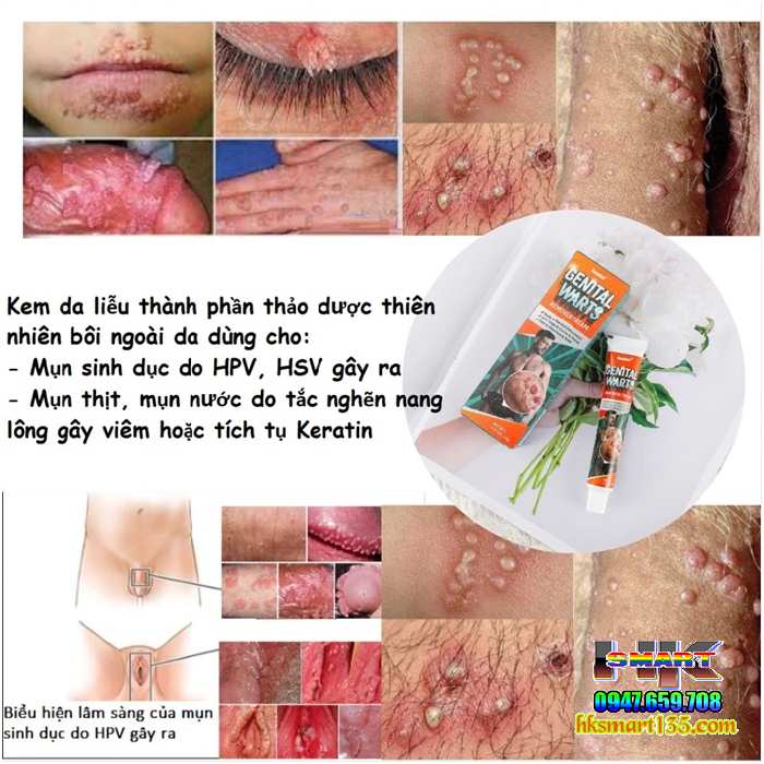 Genital Warts Sumifun- Kem Bôi Da Liễu Nẫm Ngứa Vùng Sinh Dục Do Mụn Sùi Mào Gà nhiễm Hp