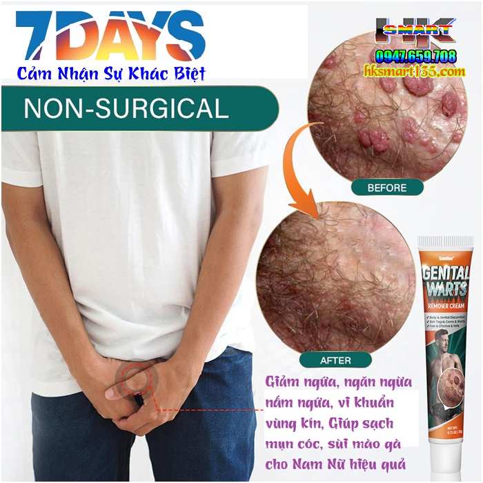Genital Warts Sumifun- Kem Bôi Da Liễu Nẫm Ngứa Vùng Sinh Dục Do Mụn Sùi Mào Gà nhiễm Hp