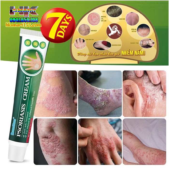 Kem Bôi Psoriasis Ointment Sumifun 20gr- Đặc Trị Các Bệnh Nấm Ngứa Vảy Nến Á Sừng