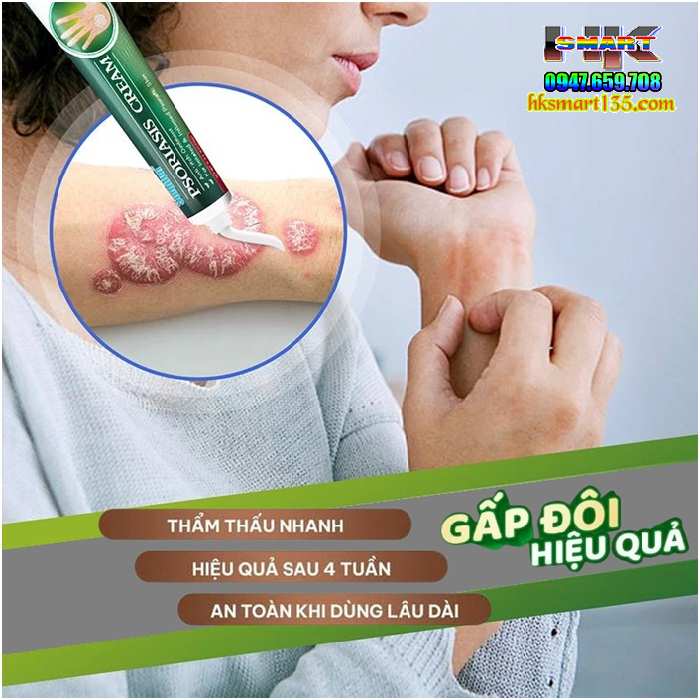 Kem Bôi Psoriasis Ointment Sumifun 20gr- Đặc Trị Các Bệnh Nấm Ngứa Vảy Nến Á Sừng