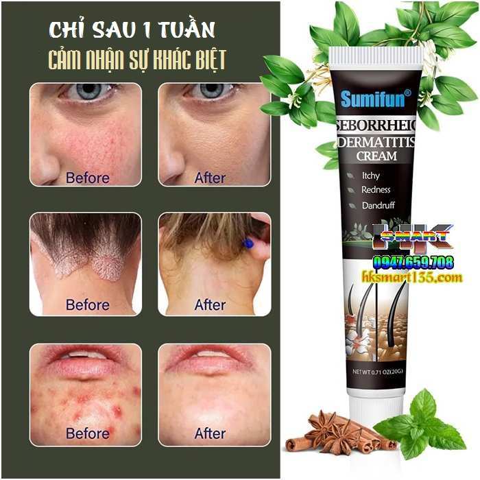 Kem bôi trị Nấm Ngứa, Vẩy Nến, Á Sừng...Chống Gàu Điều Trị Da Đầu Viêm Da Tiết Bã