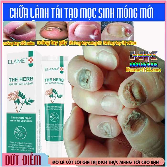 The Herb Elaimei 20gr- Kem Đặc Hiệu Loại Bỏ Nấm Móng Tay Chân