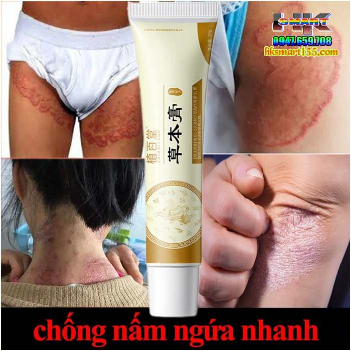 Kem bôi đặc trị viêm da cơ địa, á sừng, vảy nến Zhibaido
