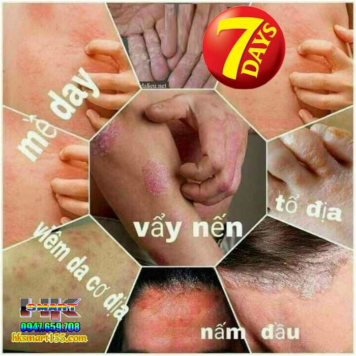 Kem bôi đặc trị viêm da cơ địa, á sừng, vảy nến Zhibaido