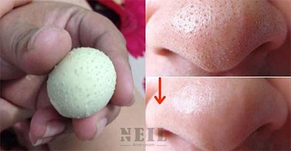 Cách trị mụn đầu đên ở mui bằng trừng gà luộc