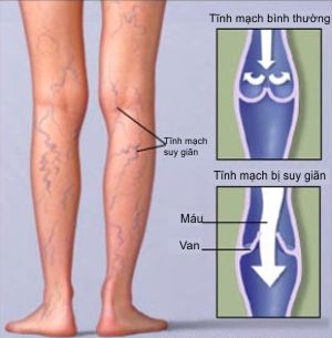 suy giãn tĩnh mạch