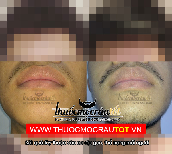 Thuốc mọc râu minoxidil 5 - 6