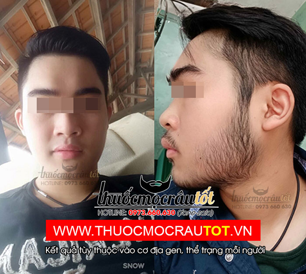 Thuốc mọc râu minoxidil 5 - 4