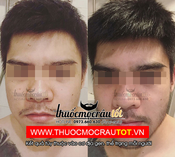 Thuốc mọc râu minoxidil 5 - 5