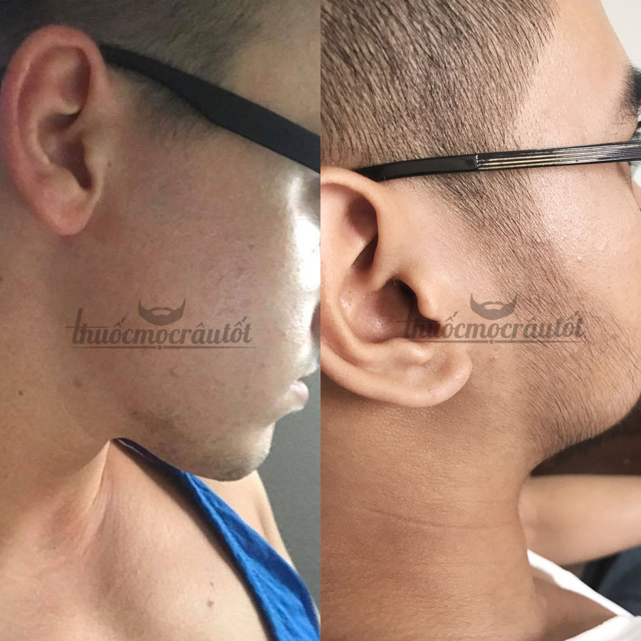 Combo Thuốc mọc râu Minoxidil 5% dạng lỏng + Biotin