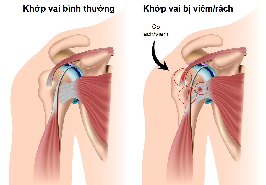 [Sức khỏe 24h kiến thức chung] Bệnh viêm khớp vai là gì? Nguyên nhân và dấu hiệu Viem-dau-nhuc-khop-vai-xuong-khop-te-te