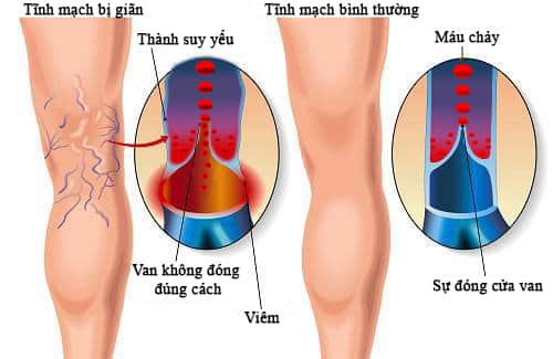 Nguyên nhân suy giãn tĩnh mạch