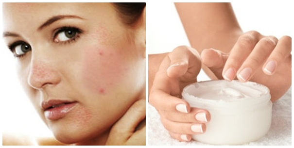 Không nên dùng quá nhiều sản phẩm trị mụn 