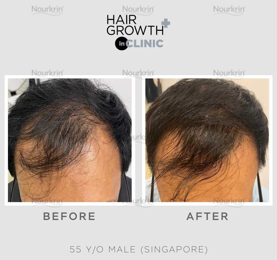 Nourkrin Hair Growth+ InClinic