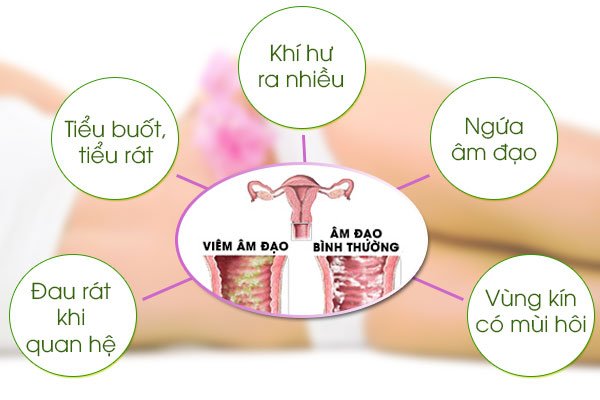 Dấu hiệu viêm nhiễm phụ khoa