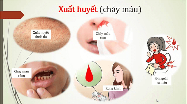 Dịch sốt xuất huyết bùng phát mạnh mẽ ở Hà Nội, cần vệ sinh nhà cửa chăn ga gối sạch sẽ để phòng tránh