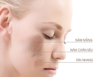 GIẢI PHÁP TRỊ NÁM CHO PHỤ NỮ 30+