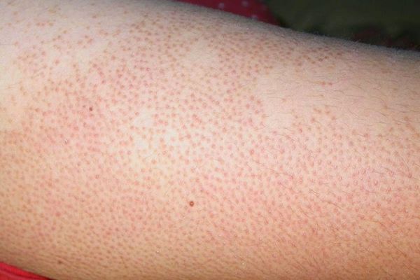 Viêm lỗ chân lông ở chân: Nguyên nhân & Cách điều trị