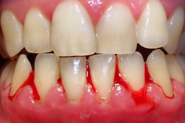 Viêm lợi: Biểu hiện, nguyên nhân, cách điều trị và phòng tránh