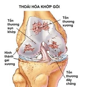 thoái hóa khớp khối 01