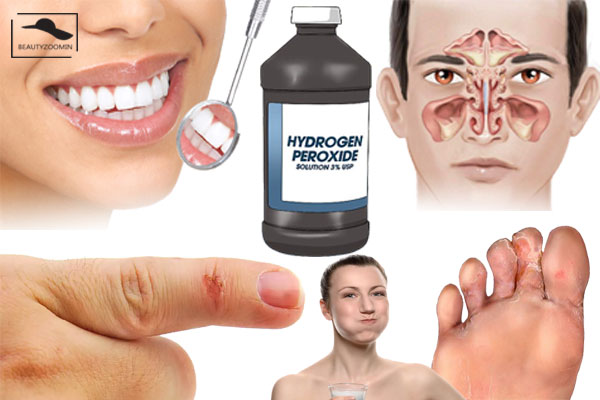 Hydrogen Peroxide bạn nên biết về 10 tác dụng của Hydrogen