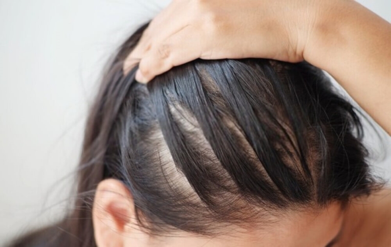 Nguyên nhân khiến da đầu bị dầu