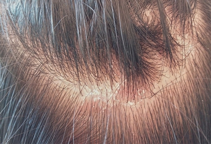 Nấm da đầu do Trichophyton gây nên