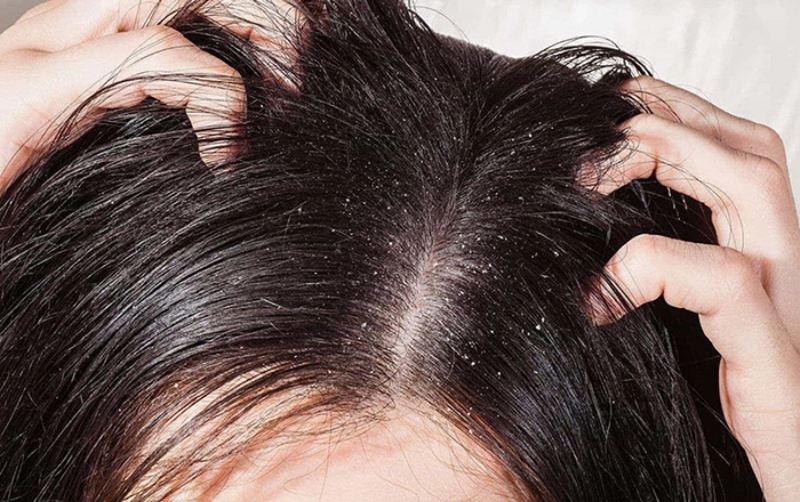 Nấm da đầu sẽ gây khó chịu và ngứa ít