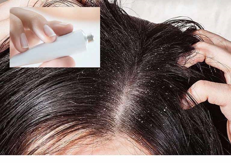 Điều trị nấm da đầu bằng thuốc