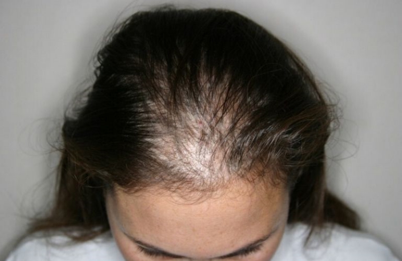 Rụng tóc androgen là gì?