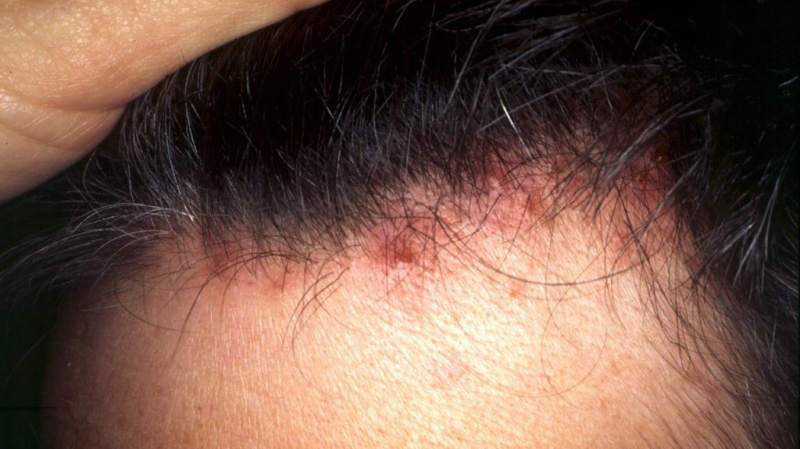 Ngứa da đầu do bị viêm nang lông