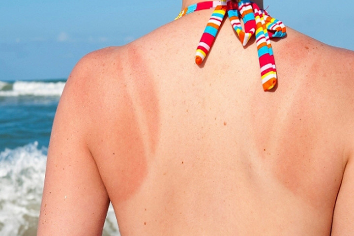 Tips chăm sóc da và phục hồi làn da cháy nắng siêu hiệu quả