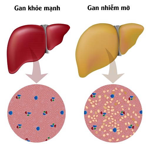 6 dấu hiệu gan của bạn đầy độc tố và làm bạn tăng cân ( và làm thế nào để dừng nó lại)