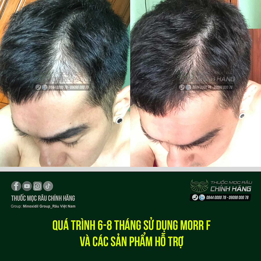 Combo mọc tóc tiết kiệm số 4 Thuốc mọc râu chính hãng