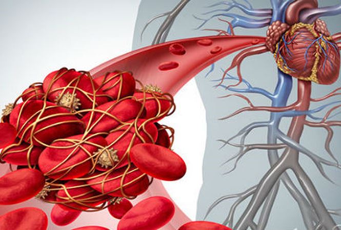 XÉT NGHIỆM D-DIMER ỨNG DỤNG TRONG LÂM SÀNG