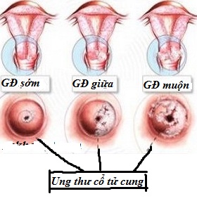 HPV - CÁC HIỂU BIẾT CƠ BẢN