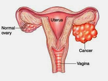 CA 125: DẤU ẤN UNG THƯ BUỒNG TRỨNG