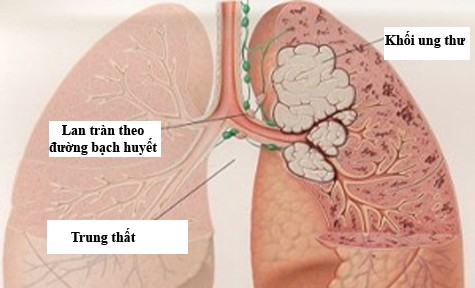 ProGRP - DẤU ẤN UNG THƯ PHỔI TẾ BÀO NHỎ