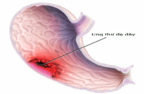 GIÁ TRỊ CỦA PEPSINOGEN I, II VÀ TỈ LỆ PEPSINOGEN I/II TRONG CHẨN ĐOÁN SỚM VIÊM TEO VÀ UNG THƯ DẠ DÀY