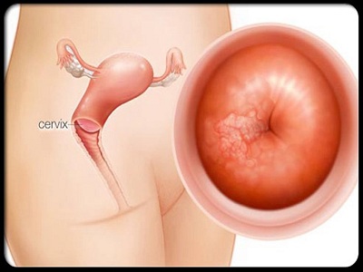 THINPREP PAP TEST - ĐỘT PHÁ TRONG TẦM SOÁT UNG THƯ CỔ TỬ CUNG