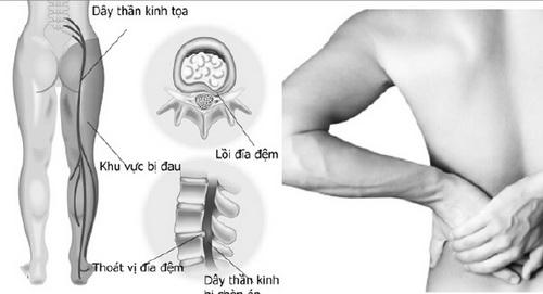 Cần làm gì khi bị đau dây thần kinh tọa?