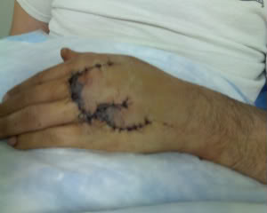 Tai nạn khi sử dụng đá mài đá cắt