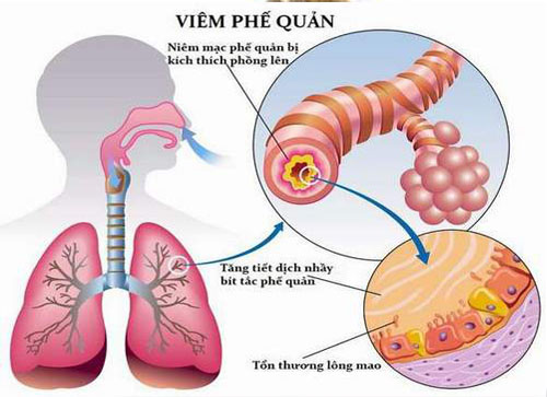 benh-viem-phe-quan-o-tre-em