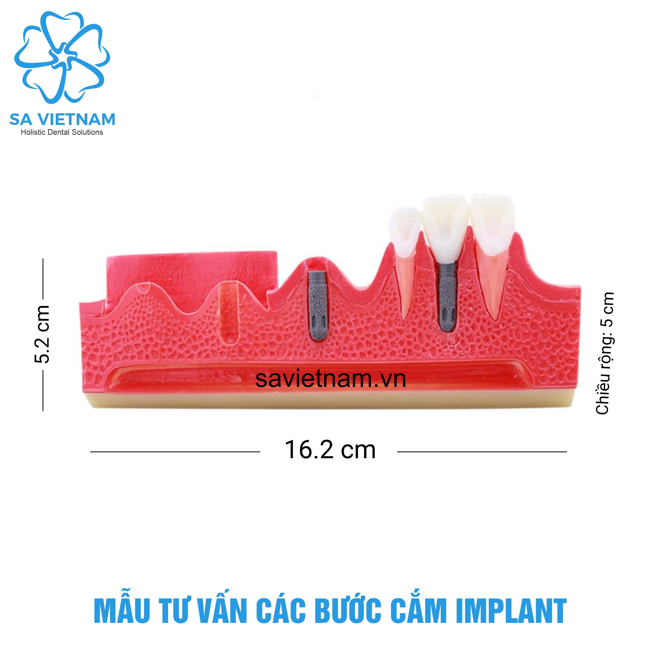 Hàm tư vấn các bước cắm implant nha khoa