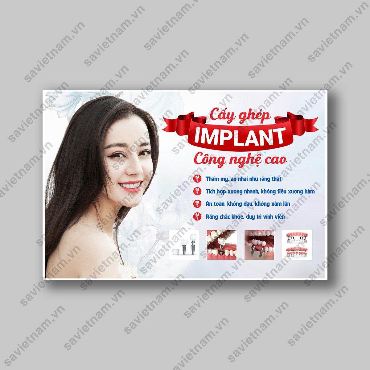 Tranh cấy ghép implant nha khoa công nghệ cao