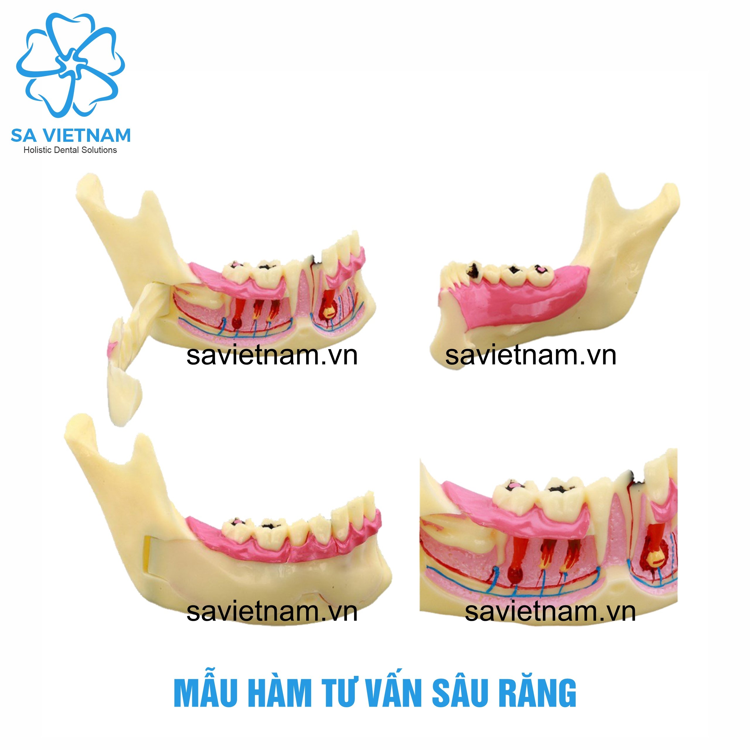 Mẫu hàm tư vấn sâu răng 