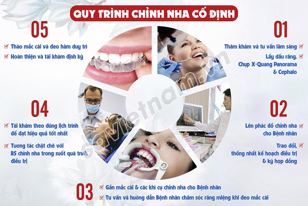 Tranh nha khoa Quy trình chỉnh nha cố định