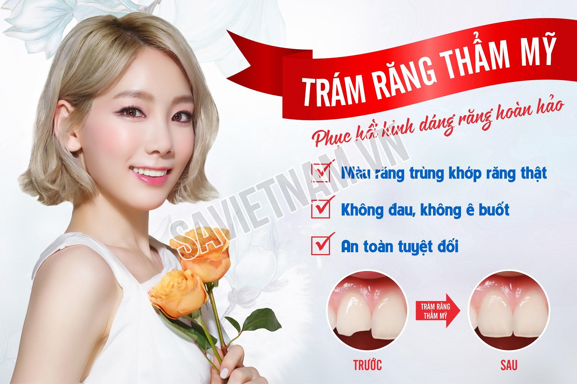 Tranh nha khoa trám răng thẩm mỹ