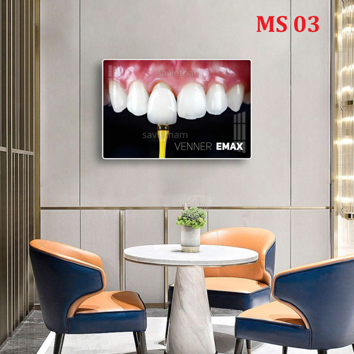 Tranh Veneer- Mặt dán sứ thẩm mỹ, Veneer Lisi, Veneer Emax