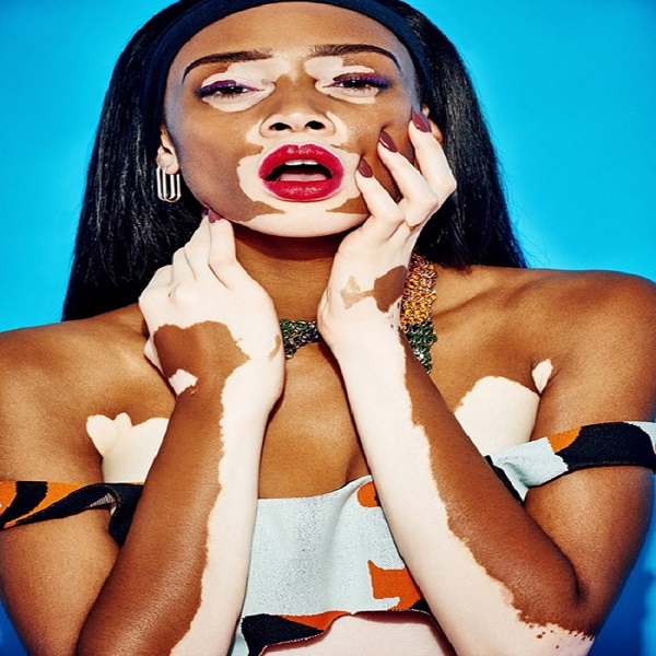 Người mẫu bạch biến Winnie Harlow - của hiếm của làng thời trang thế g